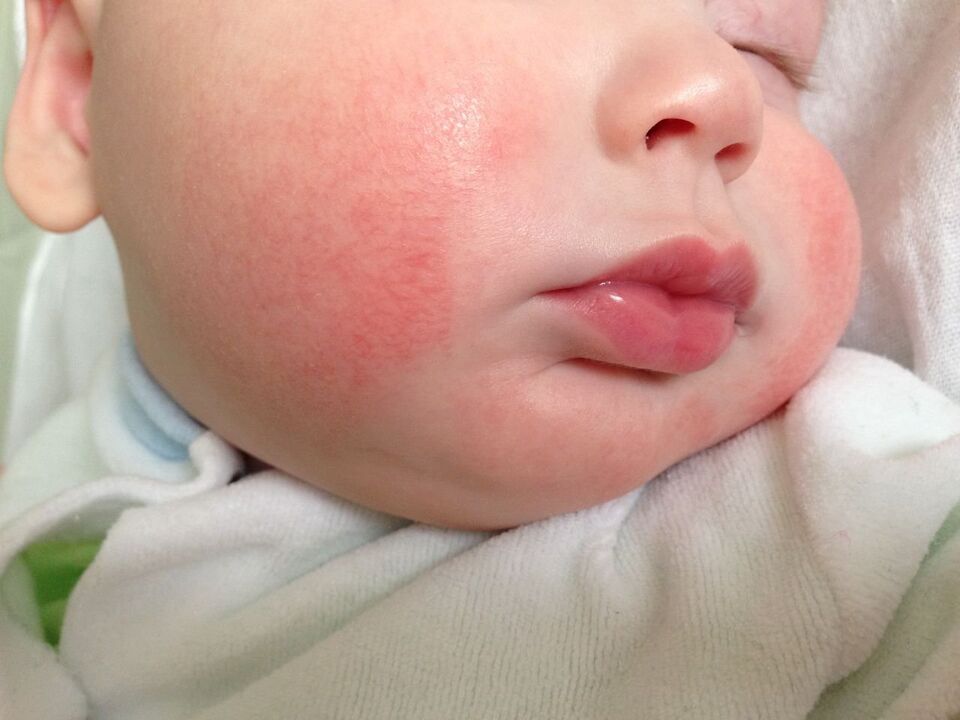 Bir çocukta solucan belirtisi alerjik ürtikerdir